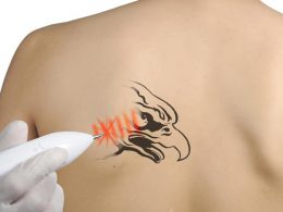 Effective tips for tattoo removal