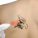 Effective tips for tattoo removal