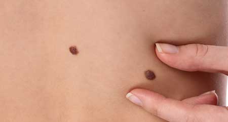 Removing skin tags at home